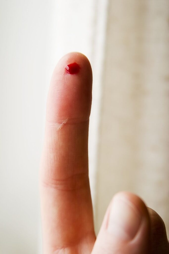 skin prick test